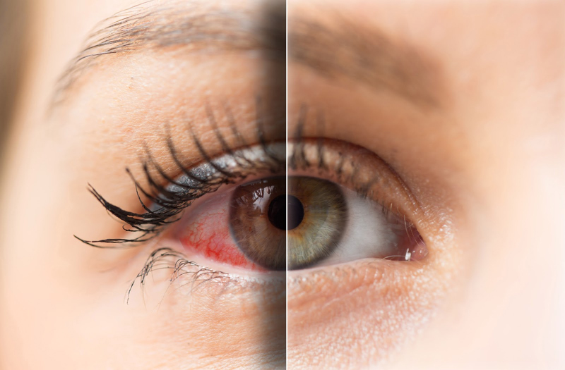 Comparison of dry eye on the left and normal eye on the right portrayed through young lady with green eyes.